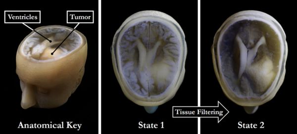 New 3D printing technique enables faster, better, and cheaper models of patient-specific medical data for research and diagnosis