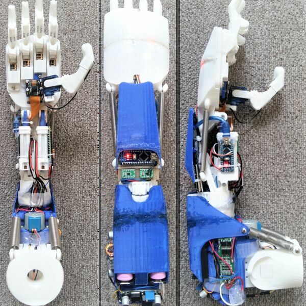 3D printed prosthesis with CV, BCI and EMG