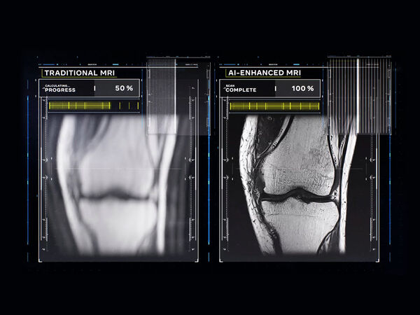 How AI Is Accelerating MRI Scans