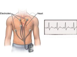 DNN Based Homemade ECG